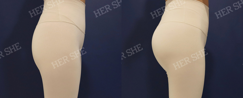 BEFORE & AFTER