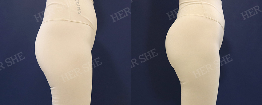 BEFORE & AFTER