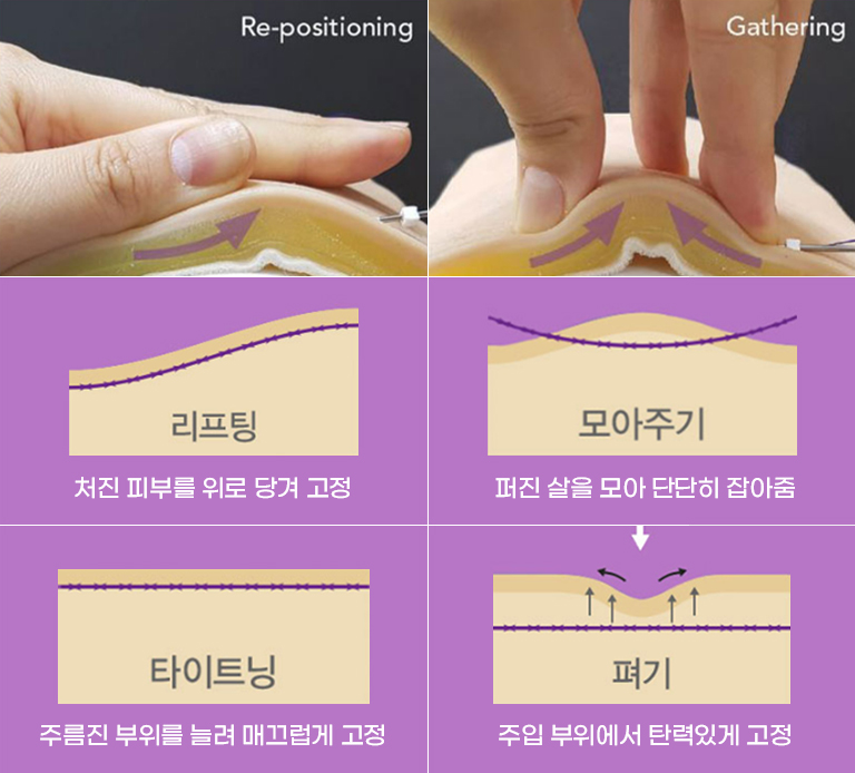 에피티콘 특허 실을 개발한 리프팅 노하우